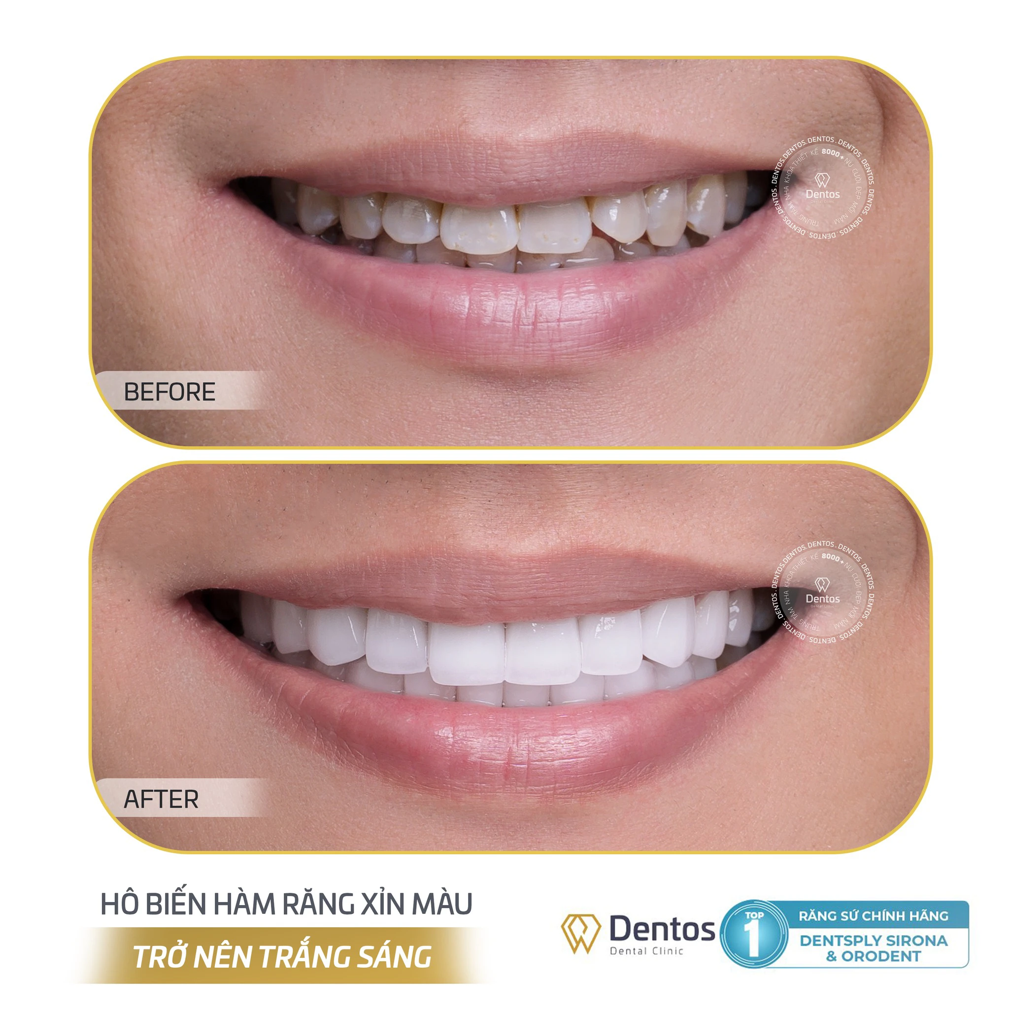 Kết quả trước và sau khi làm răng sứ của khách hàng nam tại Dentos